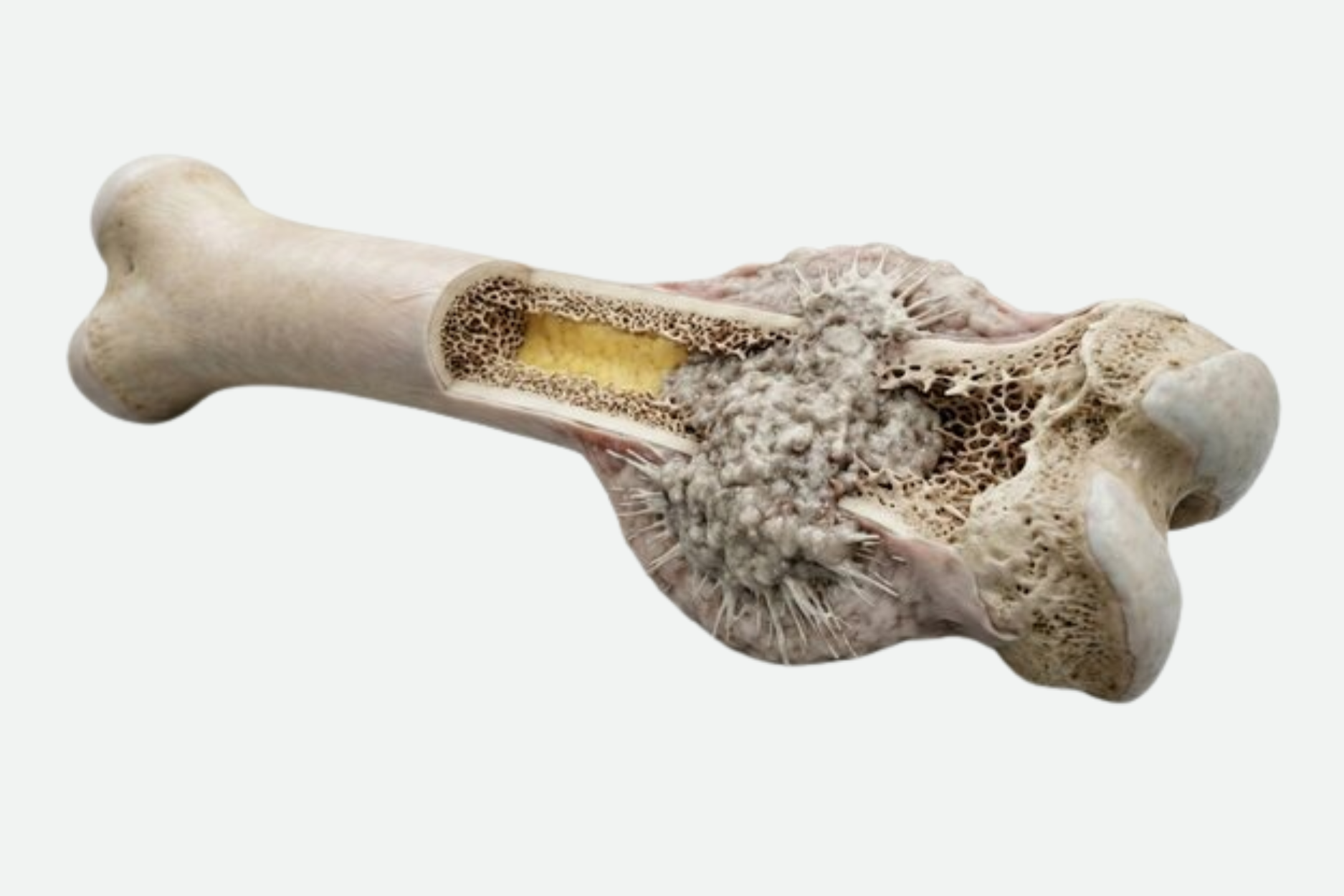 Bone tumor surgery by Dr. Jagdish Pusa — limb salvage surgery and 3D printed bone reconstruction in Hyderabad
