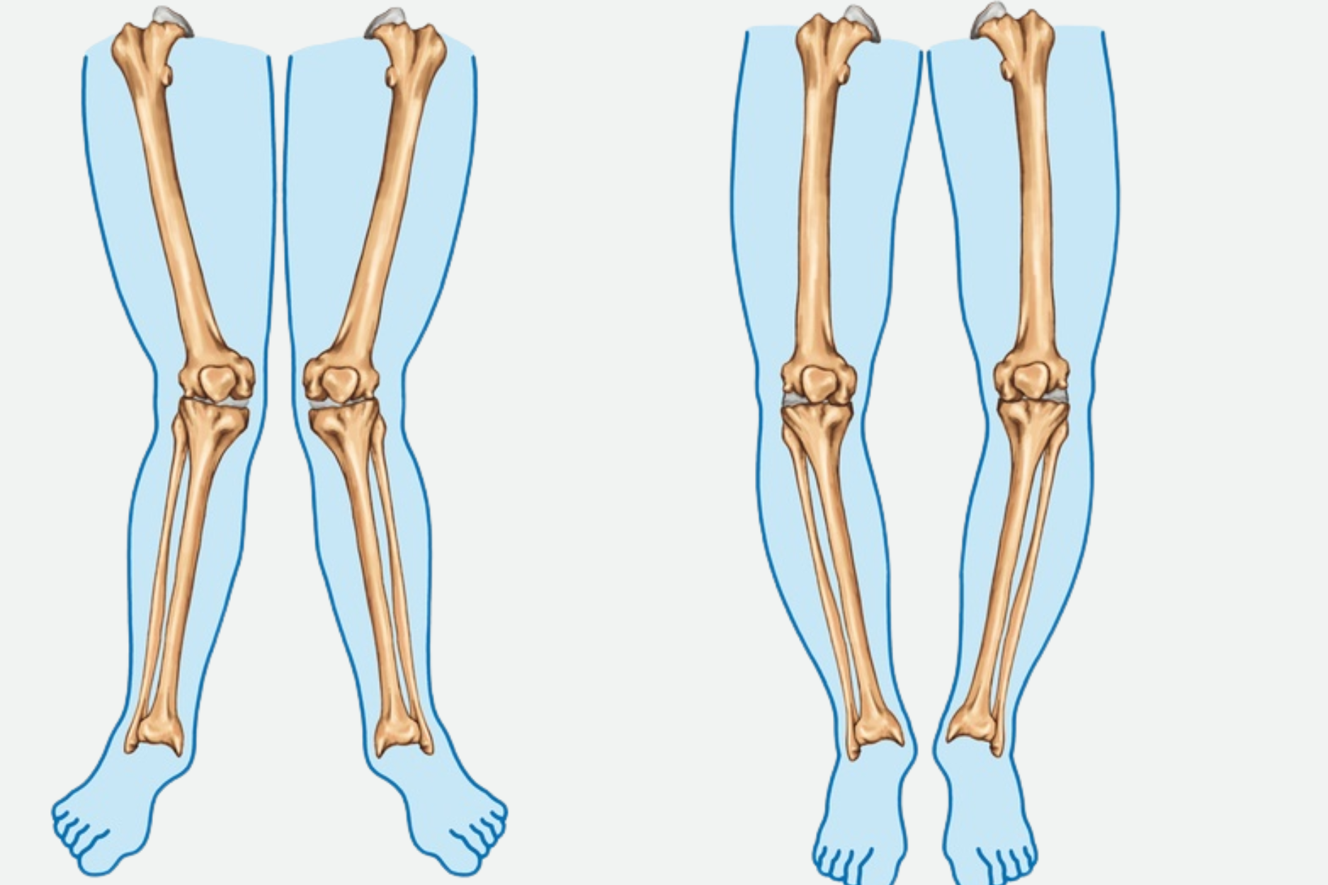 Deformity correction by Dr. Jagdish Pusa — cerebral palsy, limb deformities, and corrective orthopedic procedures in Hyderabad