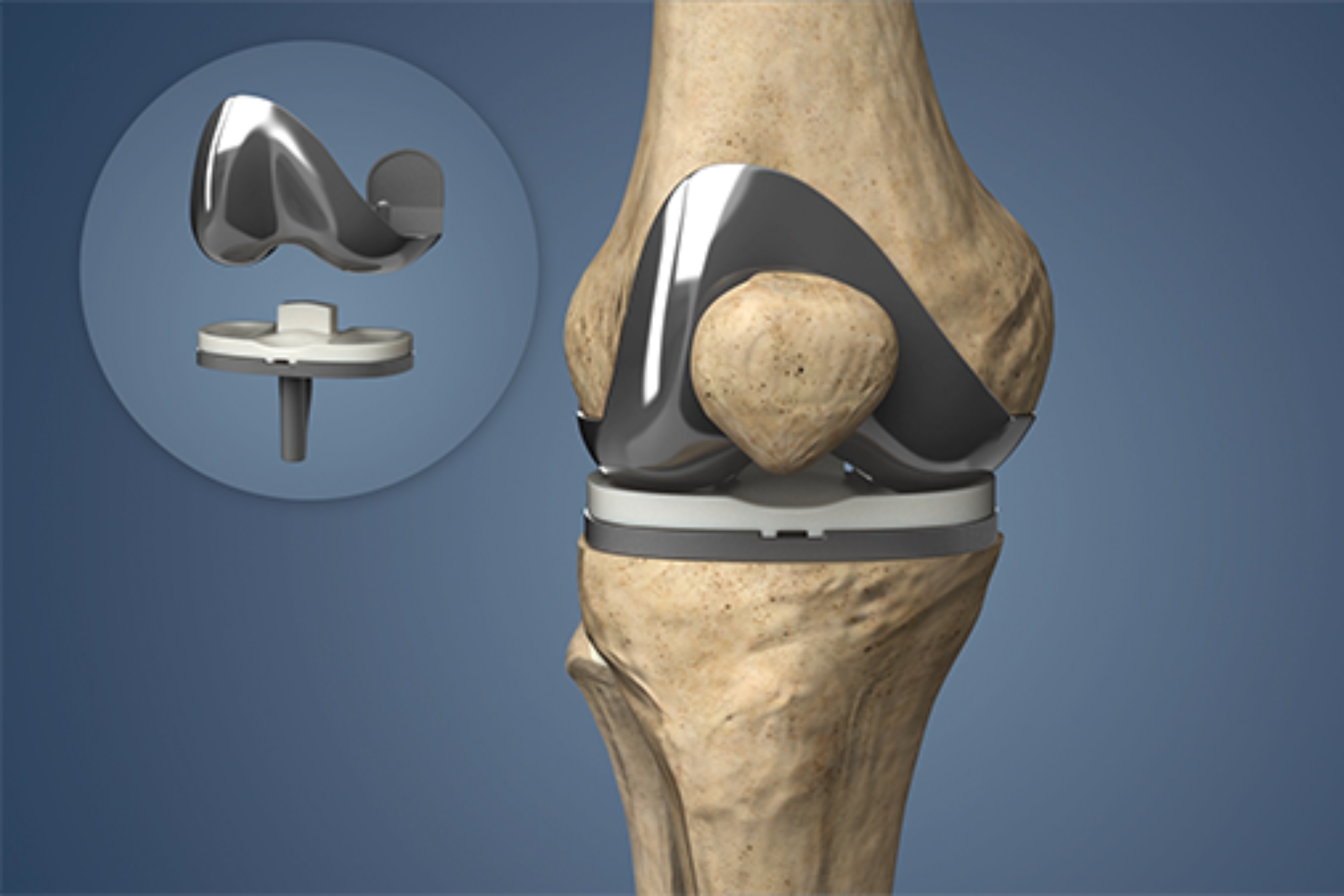 Joint replacement surgery by Dr. Jagdish Pusa — total knee replacement, revision knee replacement, hip replacement, and arthroplasty in Uppal, Hyderabad