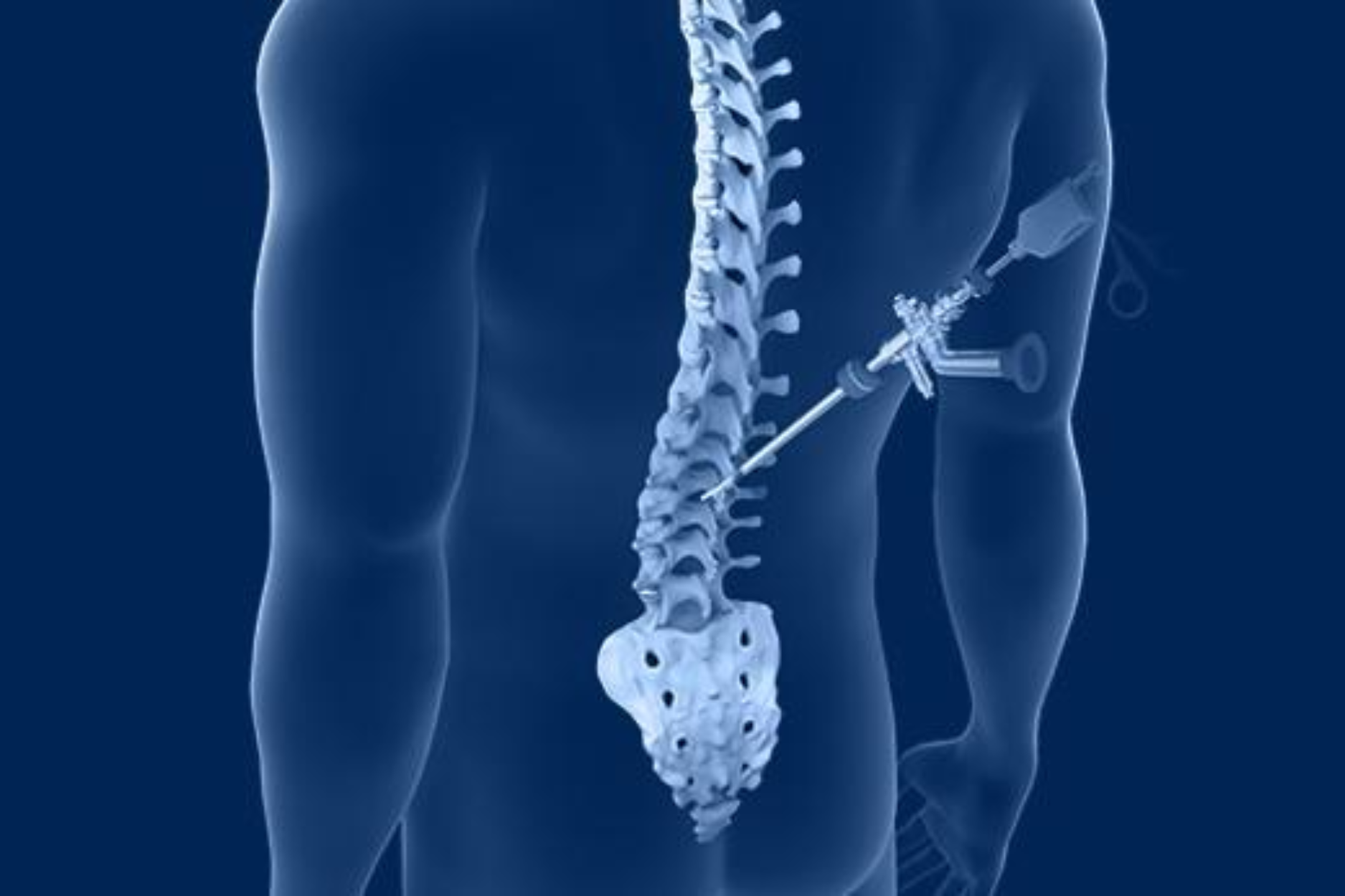 Spine surgery by Dr. Jagdish Pusa — disc problems, laminectomy, discectomy, and spine fixation in Uppal, Hyderabad